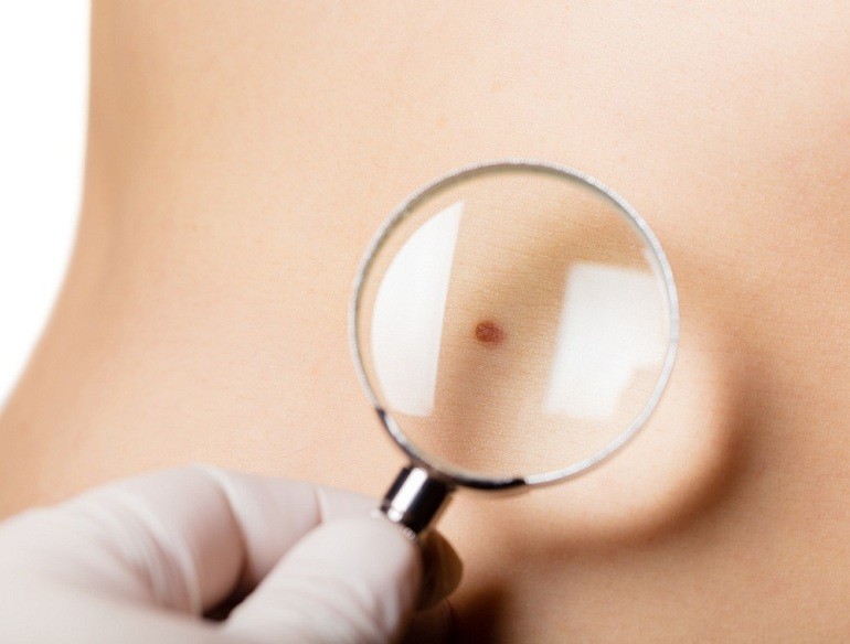 Nốt ruồi son là gì, nốt ruồi son ở đâu là may mắn, giàu có? - hình 1