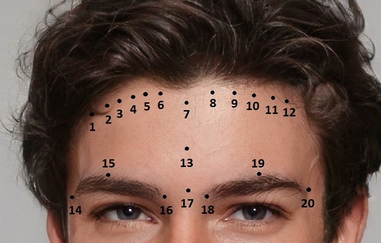 Các vị trí nốt ruồi trên khuôn mặt đàn ông tại vùng trán - hình 10