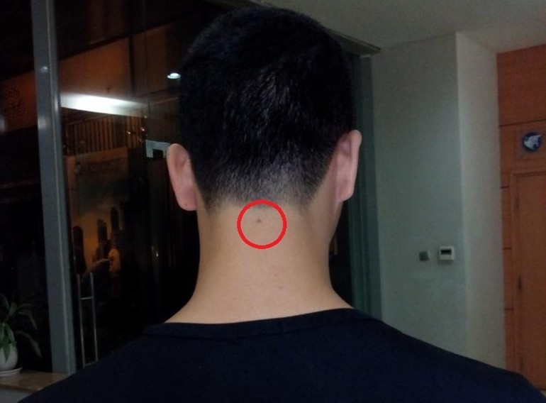 Nốt ruồi sau gáy bên trái phải của nam nữ giàu hay nghèo - Ảnh 11