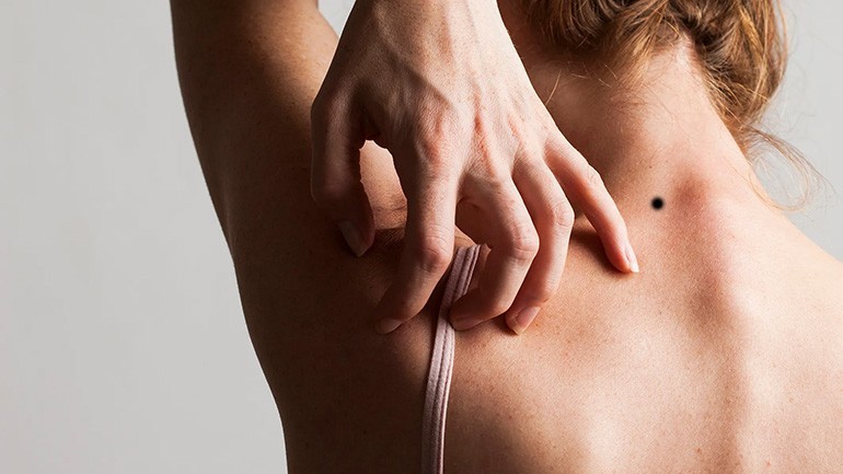 Nốt ruồi sau gáy bên trái phải của nam nữ giàu hay nghèo - Ảnh 17