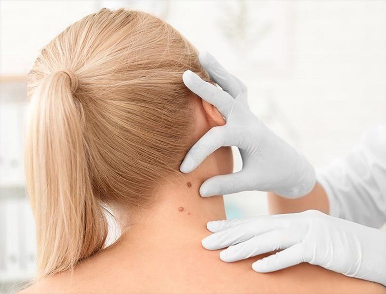 Nốt ruồi sau gáy bên trái phải của nam nữ giàu hay nghèo - Ảnh 18