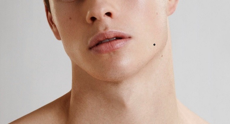 Không nên xóa nốt ruồi phú quý trên mặt - hình 19