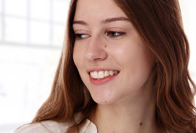 Nốt ruồi son là gì, nốt ruồi son ở đâu là may mắn, giàu có? - hình 2