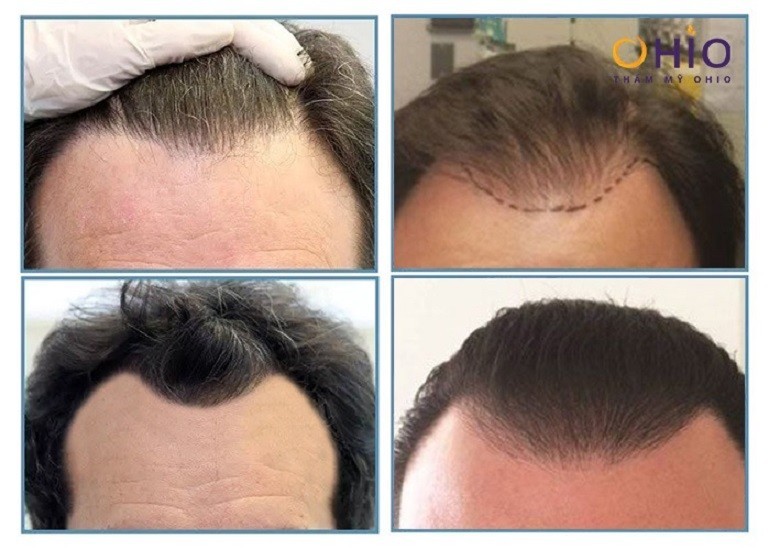 tạo hình vầng trán cao - ảnh 21