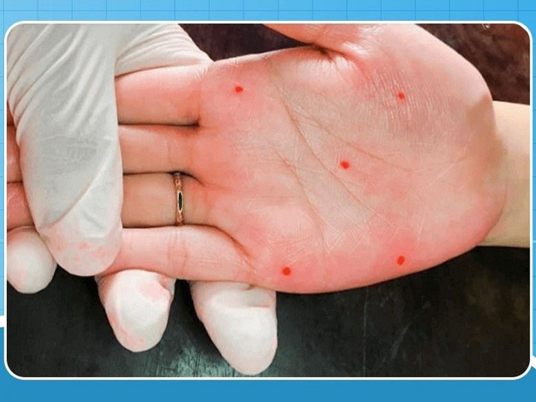 Xăm nốt ruồi hiện nay được nhiều người lựa chọn để cải vận - hình 23