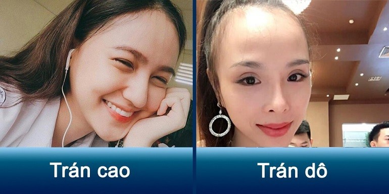 Trán cao là gì, thể hiện giàu, nghèo, độ thông minh ra sao? - Ảnh 3