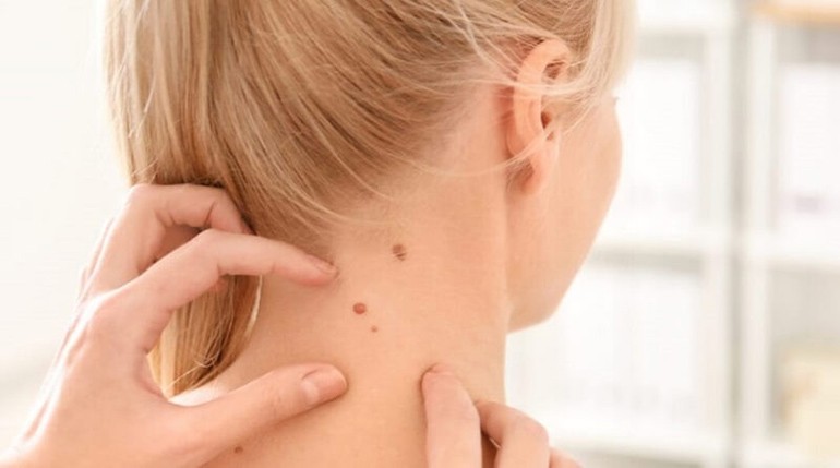 Nốt ruồi sau gáy bên trái phải của nam nữ giàu hay nghèo - Ảnh 5