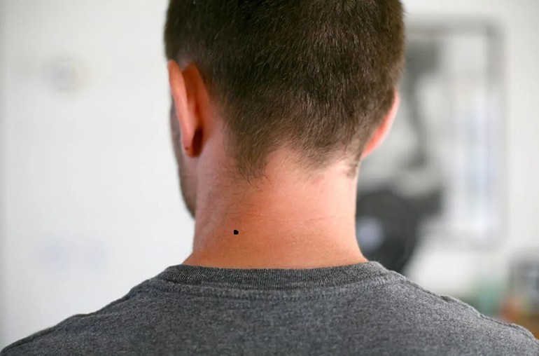 Nốt ruồi sau gáy bên trái phải của nam nữ giàu hay nghèo - Ảnh 8