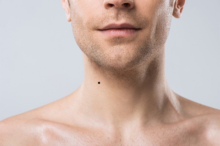 Nốt ruồi ở cổ bên trái, phải của nam, nữ giàu hay nghèo - Ảnh 2