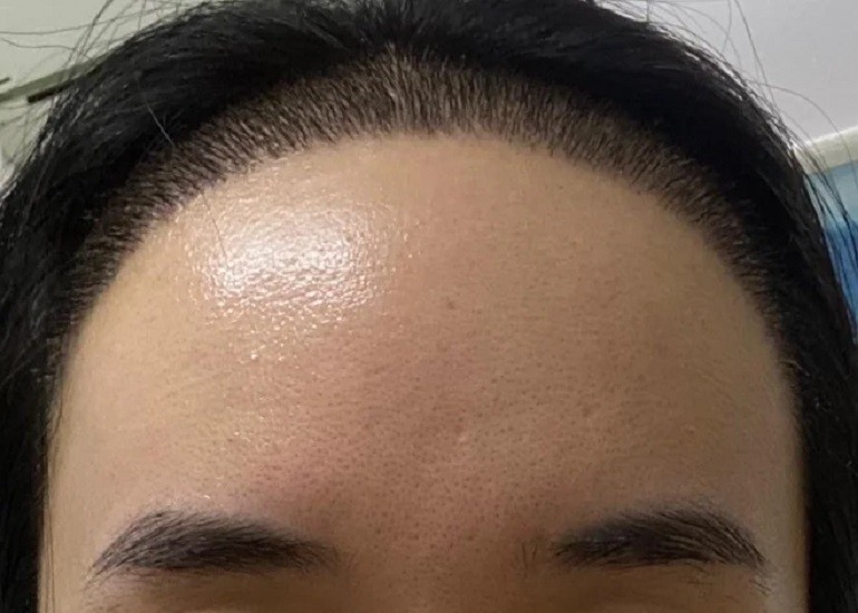 Lựa chọn phương pháp cấy tóc giúp trán bớt dô - Ảnh 22